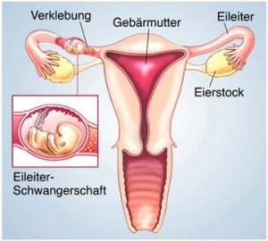 Schwangerschaft im Eileiter