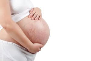 Schwangere Frau mit Schwangerschaftsstreifen