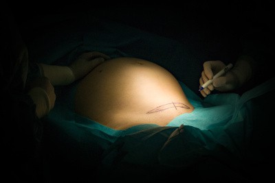 Schwangere Frau im Operationsaal bekommt Kaiserschnitt